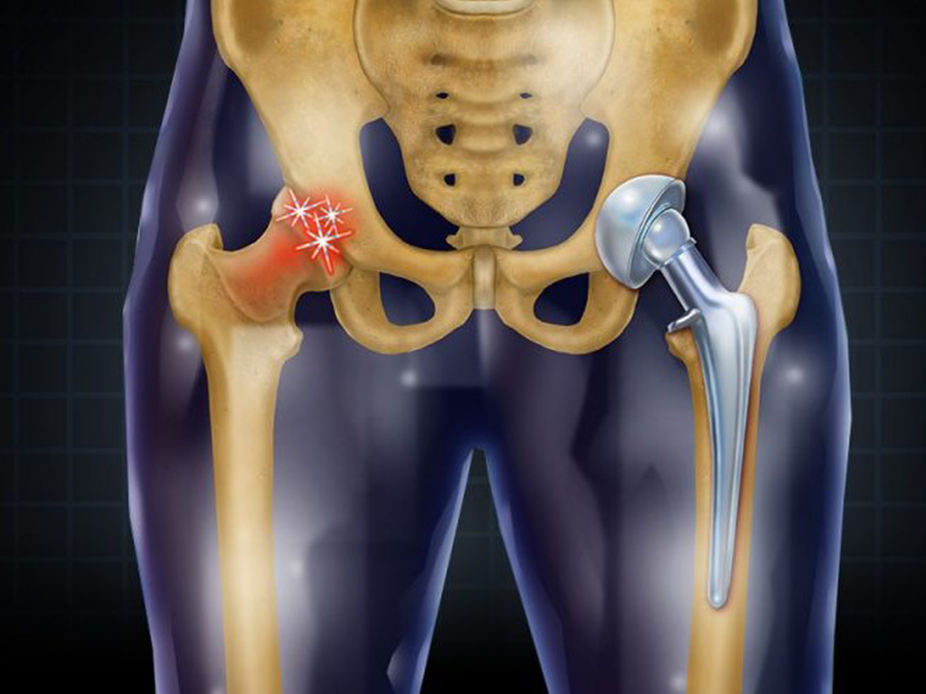 Joint replacement surgeon in Delhi NCR